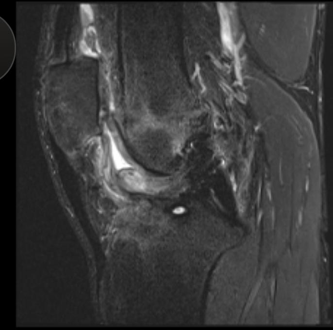 MRI of the knee from the side showing the cyclops lesion